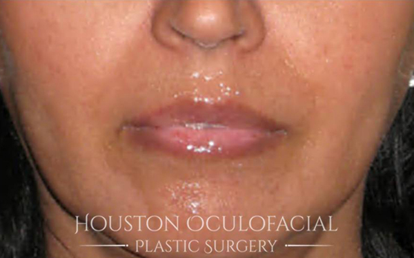 Lip Augmentation