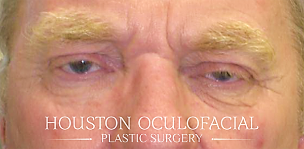 Upper Eyelid Blepharoplasty