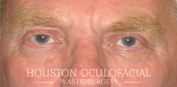 Upper Eyelid Blepharoplasty