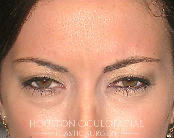 Botox ® Injections Case 4768 After Photo Botox ® Injections