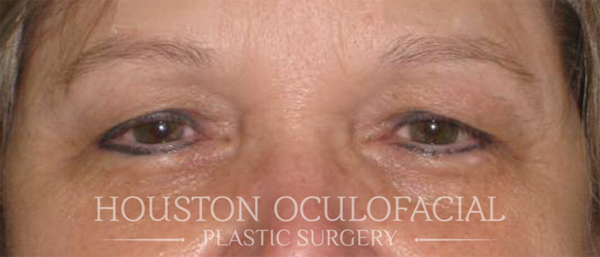 Upper Eyelid Blepharoplasty