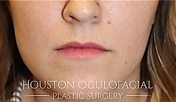 Lip Augmentation Case 4777 Before Photo Lip Augmentation