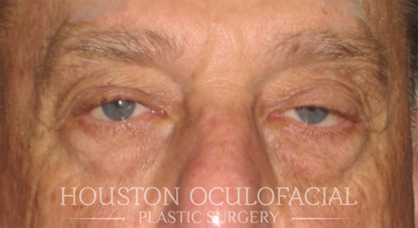 Upper Eyelid Blepharoplasty