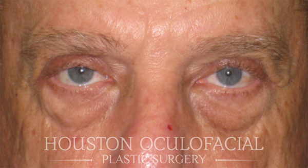 Upper Eyelid Blepharoplasty