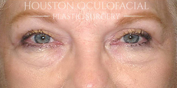 Upper Eyelid Blepharoplasty