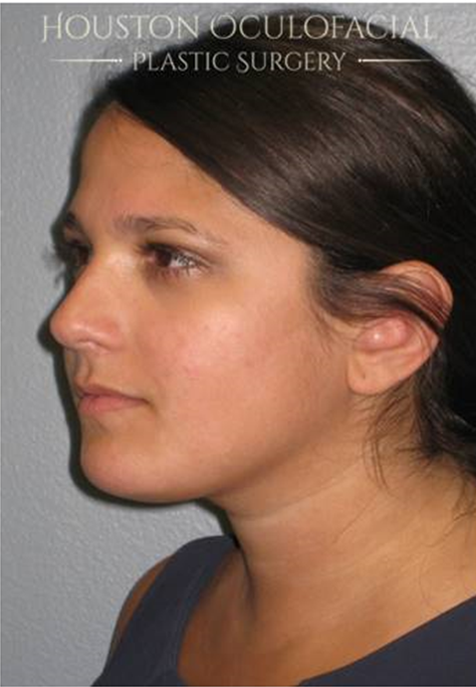Kybella ® Case 4787 After Photo Kybella ®