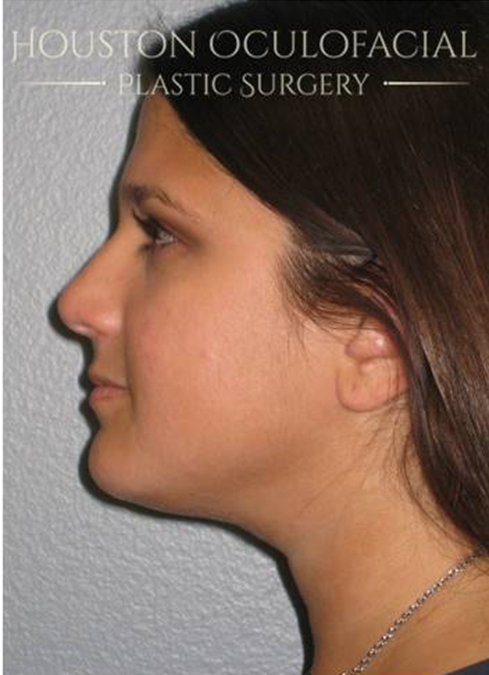 Kybella ® Case 4787 After Photo Kybella ®