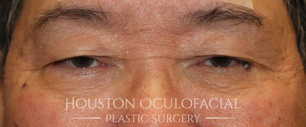 Asian Blepharoplasty