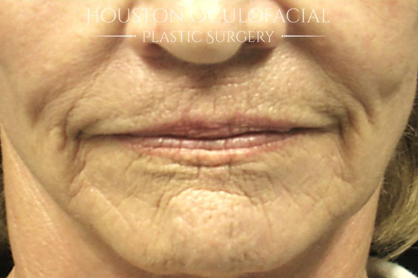 Laser Skin Resurfacing