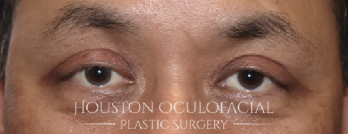 Upper Eyelid Blepharoplasty