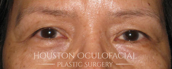 Asian Blepharoplasty Case 4810 Before Photo Asian Blepharoplasty
