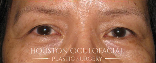 Asian Blepharoplasty