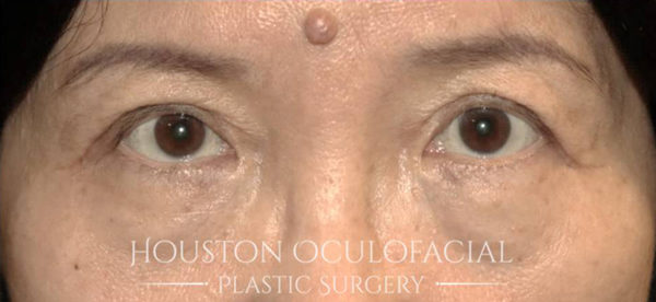 Ptosis (Droopy Eyelid) Repair Case 4816 After Photo Ptosis (Droopy Eyelid) Repair