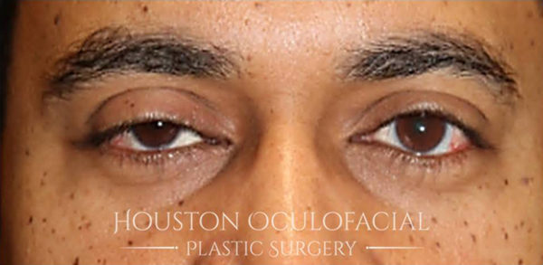 Ptosis (Droopy Eyelid) Repair Case 4819 Before Photo Ptosis (Droopy Eyelid) Repair