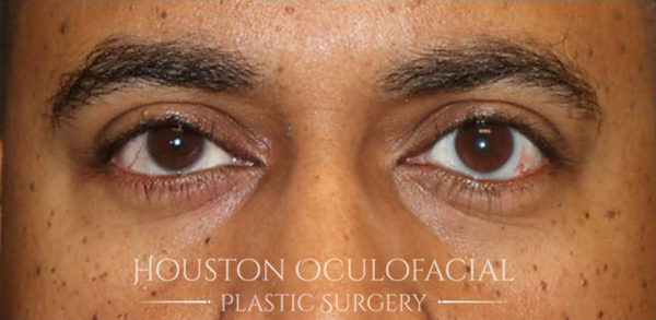 Ptosis (Droopy Eyelid) Repair Case 4819 After Photo Ptosis (Droopy Eyelid) Repair