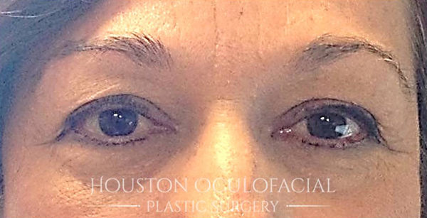 Upper Eyelid Blepharoplasty