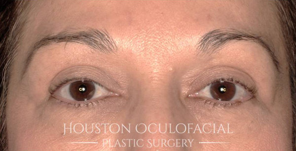 Upper Eyelid Blepharoplasty