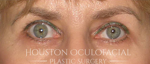 Eyelid Retraction Repair