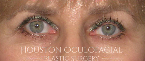 Eyelid Retraction Repair