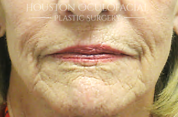 Laser Skin Resurfacing Case 4801 Before Photo Laser Skin Resurfacing