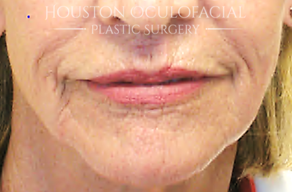Laser Skin Resurfacing Case 4801 After Photo Laser Skin Resurfacing