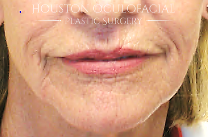 Laser Skin Resurfacing