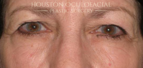 Upper Eyelid Blepharoplasty