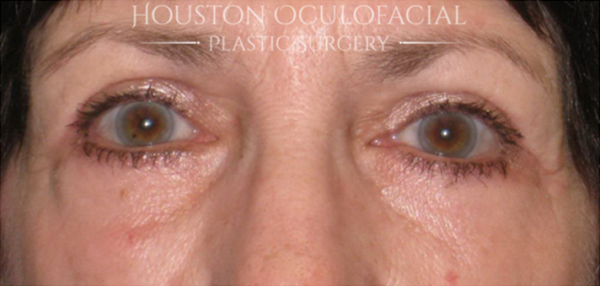 Upper Eyelid Blepharoplasty