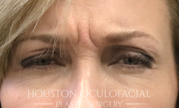 Botox ® Injections Case 5051 Before Photo Botox ® Injections