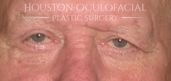 Eyelid Reconstruction Case 5057 After Photo Eyelid Reconstruction