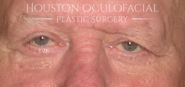 Eyelid Reconstruction