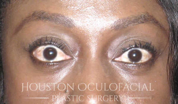 Eyelid Retraction Repair