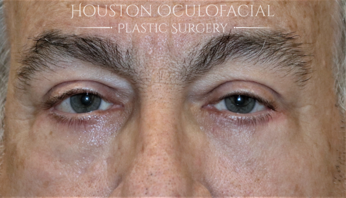 Lower Eyelid Blepharoplasty