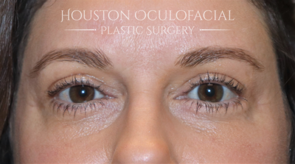 Lower Eyelid Blepharoplasty