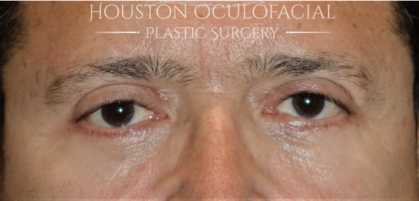 Lower Eyelid Blepharoplasty