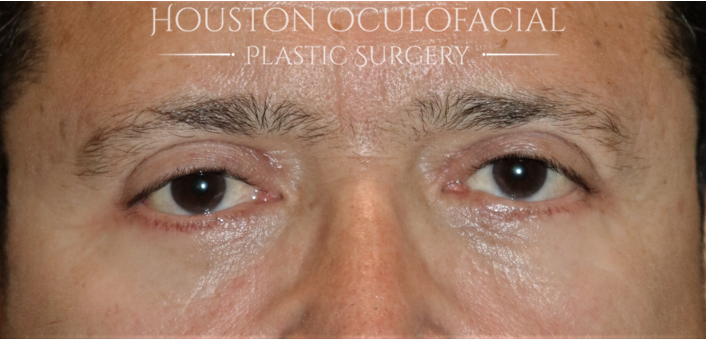 Lower Eyelid Blepharoplasty