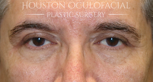 Lower Eyelid Blepharoplasty