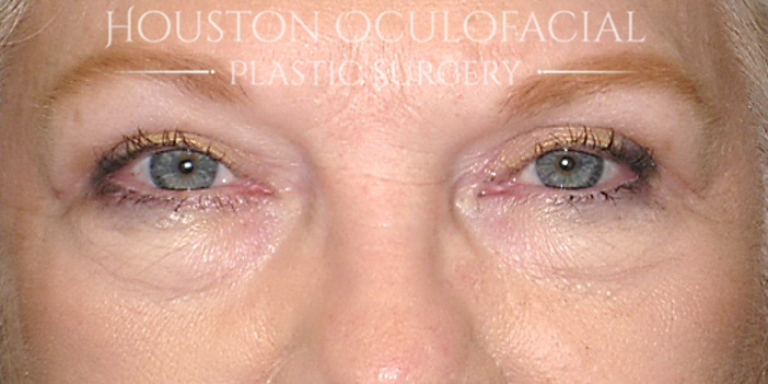 Lower Eyelid Blepharoplasty