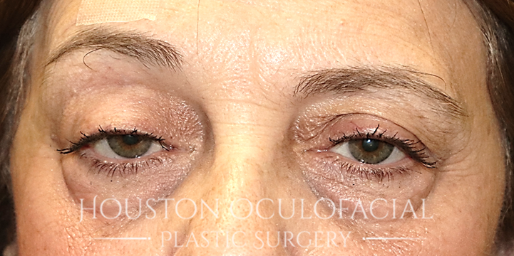 Ptosis (Droopy Eyelid) Repair