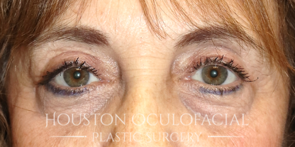 Ptosis (Droopy Eyelid) Repair