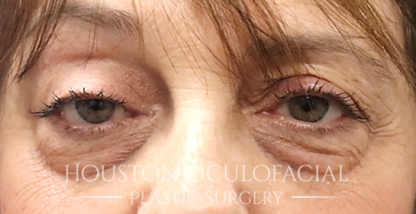 Ptosis (Droopy Eyelid) Repair