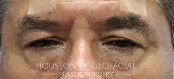 Upper Eyelid Blepharoplasty Case 5128 Before Photo Upper Eyelid Blepharoplasty