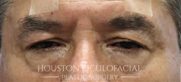 Upper Eyelid Blepharoplasty