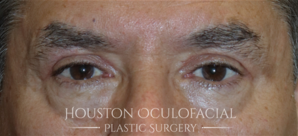 Upper Eyelid Blepharoplasty Case 5128 After Photo Upper Eyelid Blepharoplasty