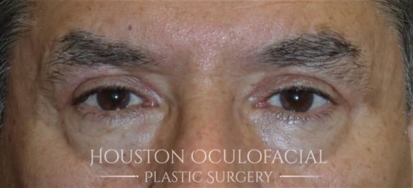 Upper Eyelid Blepharoplasty