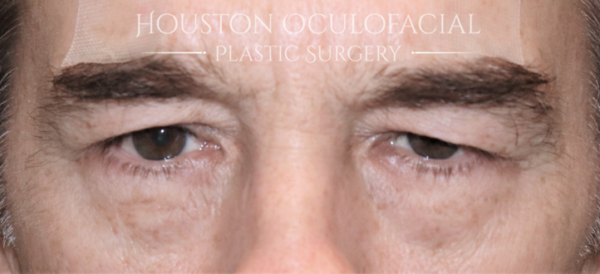 Upper Eyelid Blepharoplasty