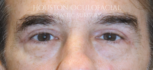 Upper Eyelid Blepharoplasty