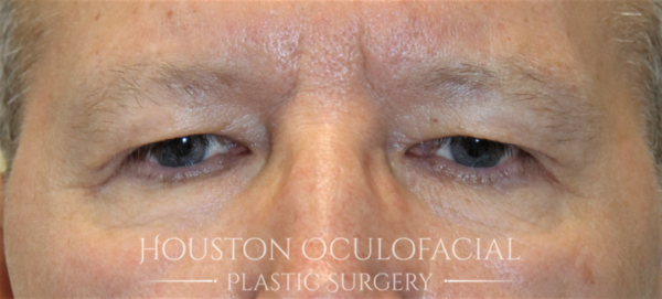 Upper Eyelid Blepharoplasty