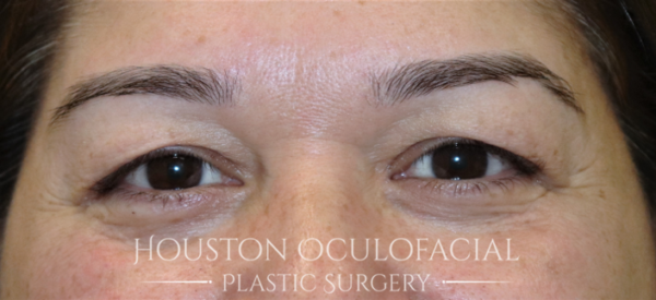 Upper Eyelid Blepharoplasty