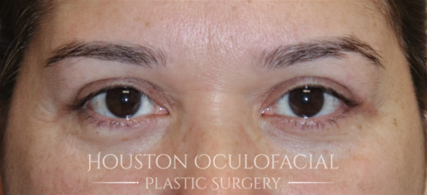 Upper Eyelid Blepharoplasty